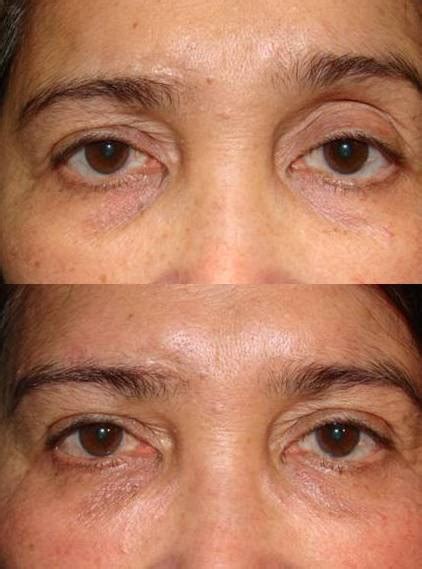 Revision Eyelid Surgery Revision Brow Lift Surgery Dr Guy Massry