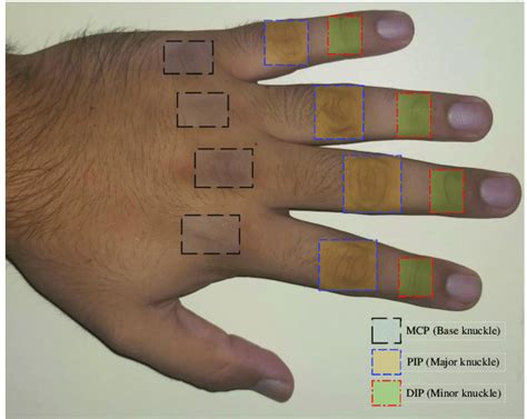 Depiction Of Mcp Pip And Dip Joints On Dorsal View Of Hand