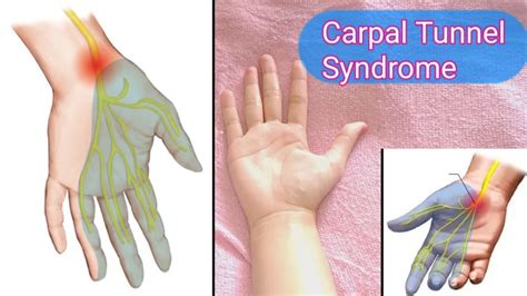 Tutorial Massage Carpal Tunnel Syndrome Hand Reflexology Youtube