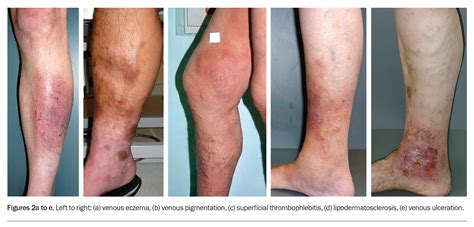 Varicose Veins More Than A Cosmetic Concern Medicine Today