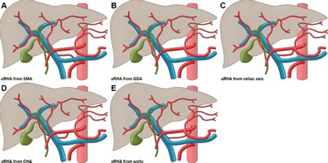 Anatomic Variations Of The Hepatic Artery In 5625 Patients Radiology