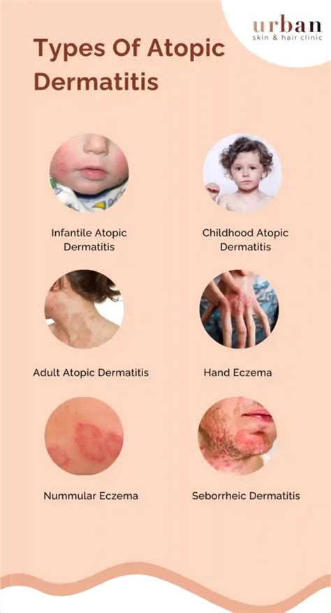 Atopic Dermatitis Types Causes And Symptoms Ushc