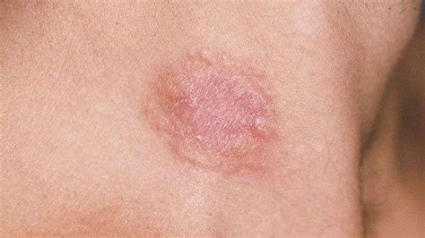 Leukemia Red Spots On Skin
