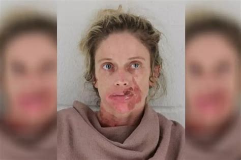 Woman Gets Instant Frostbite On Her Face After Huffing Canned Air At Walmart Photo