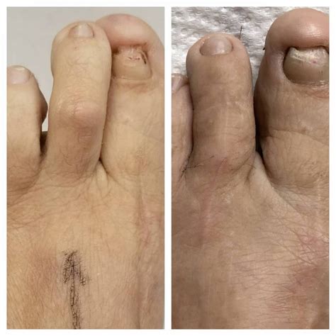 What Is Aesthetic Toe Straightening Surgery