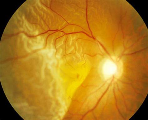 What You Must Know About Retinal Detachments Eyeguru