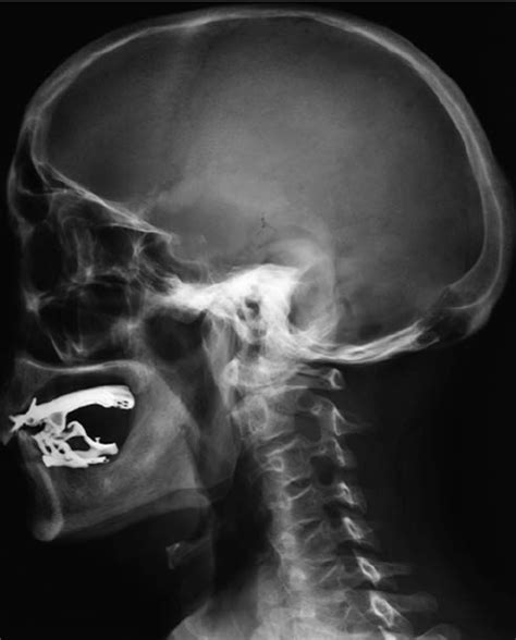 Skull And Cervical X Ray Showing An Osteolytic Lesion Of The Occipital