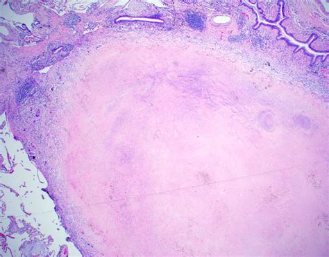 Pathology Outlines Tuberculosis