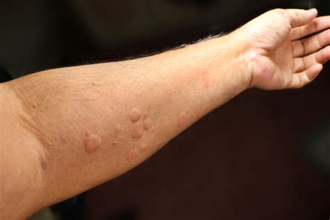 Skin Rashes Covid 19 Pandemic Dr Michael Steppie