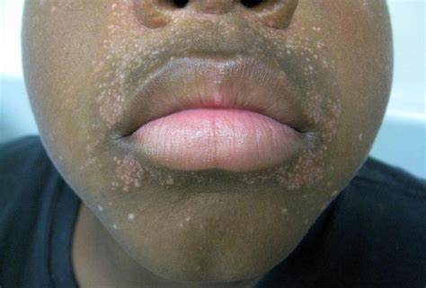 Perioral Dermatitis In A Child Associated With An Inhalation Steroid