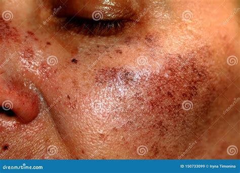 Pigmented Spots On The Face Pigmentation On Cheeks Stock Image Image