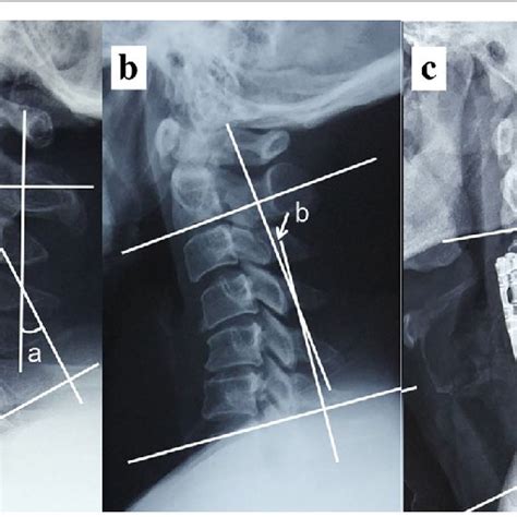 The Cervical Lordosis Cl Namely As C2 7 Cobb Angle Was Calculated