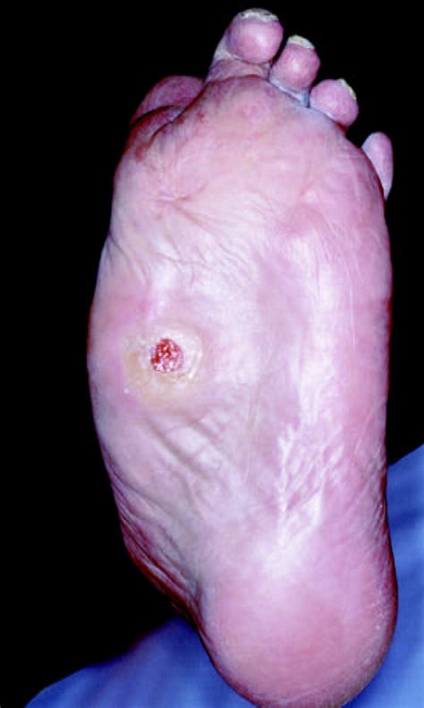 The Charcot Foot The Lancet