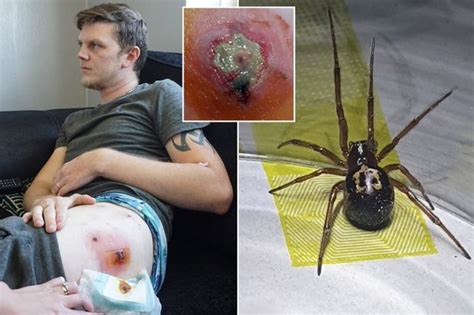 Dad Bitten Five Times By False Widow Spiders In Bed Is Left Unable To