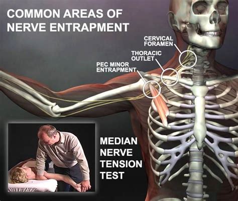 Common Areas Of Nerve Entrapment Massage Therapy Nerve Entrapment