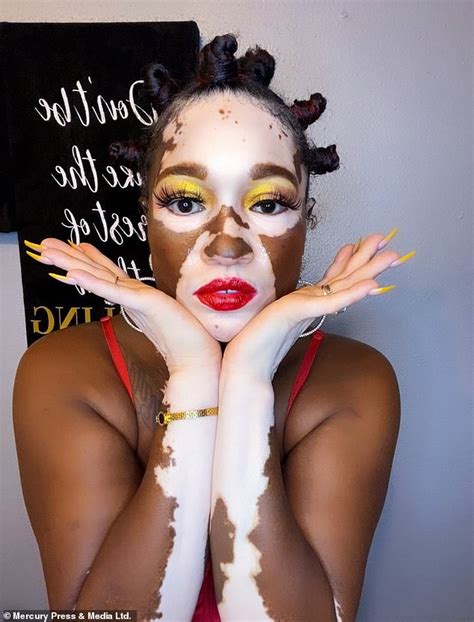 Black Woman 42 With Vitiligo Reveals Strangers Fixate On Her Like