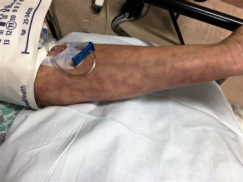 Bacteria can enter skin through wounds or skin inflammation, or through the openings made with intravenous (iv) catheters (tubes inserted into the body to give or drain fluids). Case Study: Mottling and Infection in an Adult - The Clinical Advisor