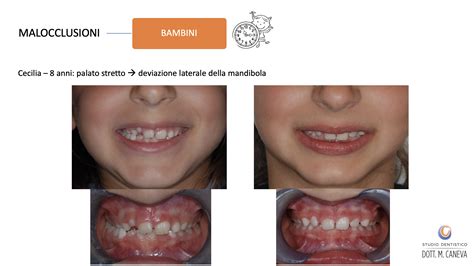 Studio Dentistico Caneva Disallineamento Dei Denti Malocclusioni