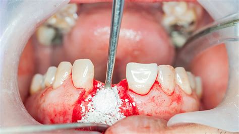 Bone Grafting And Ridge Preservation Wisdom Teeth And Oral Surgery Center