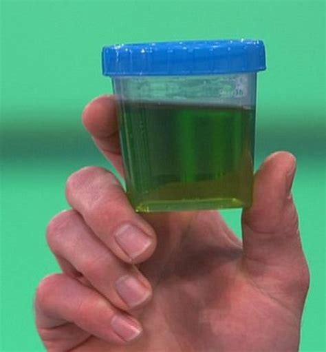 Green Urine Symptoms Causes Treatment Medication Hubpages