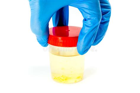 Amostra de urina com luva imagem de stock. Imagem de recipiente - 31397163