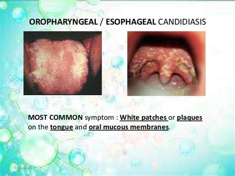 Candidiasis Moniliasis Oral Thrush Yeast Infections