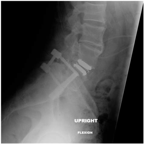 Albums 90 Images L4 L5 S1 Operating Room Lumbar Spinal Fusion Surgery