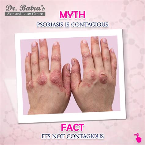 Myth Psoriasis Dr Batras Skin Clinic And Laser Centre