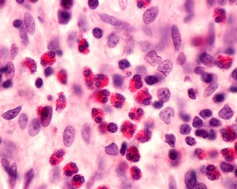 High Blood Eosinophil Count Linked To Asthma Related Hospital