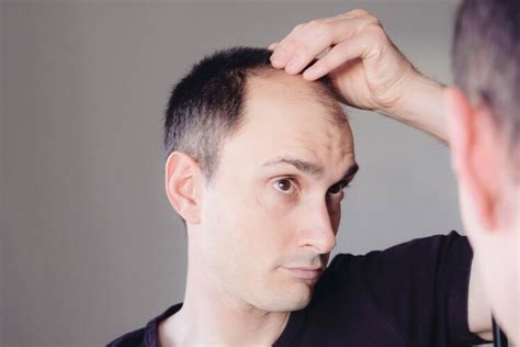 What Every Man Should Know About Male Pattern Baldness Happy Head