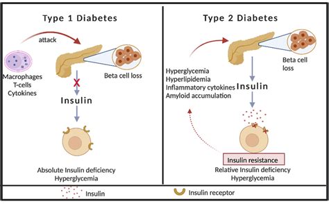 Pathogenesis Of Type And Type Diabetes In Type Diabetes Download Scientific Diagram