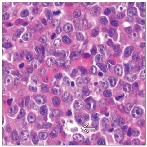 Diffuse Large B Cell Lymphoma Nos Immunoblastic Basicmedical Key