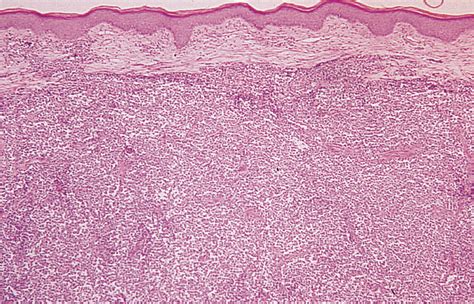 Proptosis With Violaceous Dermal And Subcutaneous Skin Nodules In An