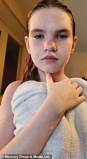 Mother Reveals Her Daughter 12 Is So Allergic To Water That Having A
