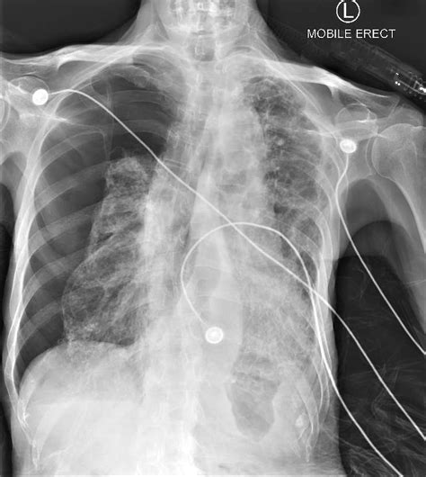 Tension Pneumothorax X Ray
