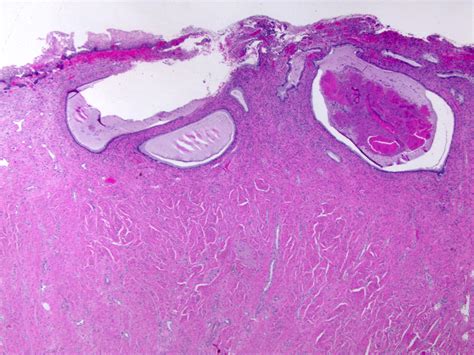 pathology outlines nabothian cysts