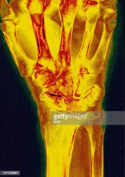Post Traumatic Wrist Arthritis X Ray Of Left Hand News Photo Getty
