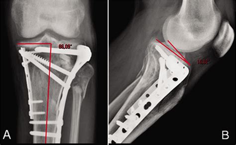 Complex Tibial Plateau Fractures A Retrospective Study And Proposal Of