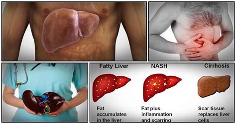 http://liverbasics.com/fatty-liver-solution.html Analysis of the Fatty ...