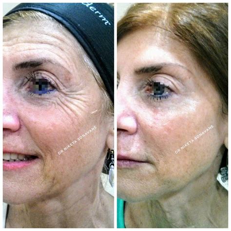 full face botox in 60 yr old female by top dermatologist in mumbai dr niketa sonavane dr