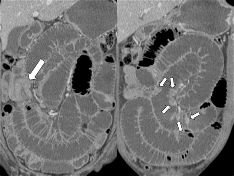 A 67 Year Old Man With Small Bowel Obstruction By Intussusception