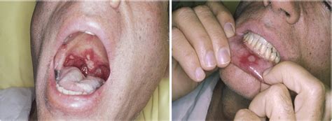 Apthous Ulcers Large Oral Ulcers In Patient Infected GrepMed