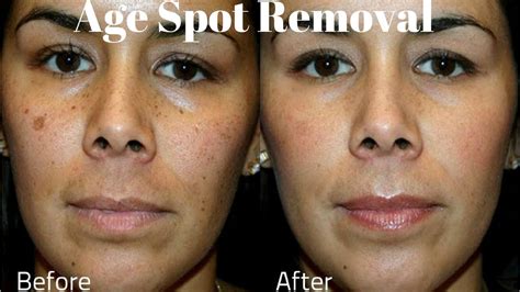 Age Spots Removal On Face Home Remedies To Remove Age Spots Youtube