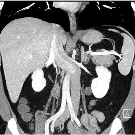Abdominal Ct Showing Ivc Located At The Left Side Of The Aorta