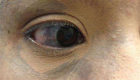 Derm Dx Blue Mark On The Face And Eye Clinical Advisor