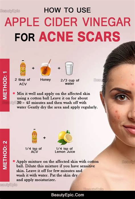 How To Remove Acne Scars Quickly With Apple Cider Vinegar
