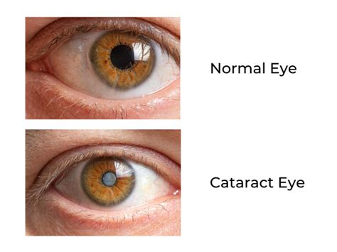What Are Cataracts Lasik Denver Cataract Surgery