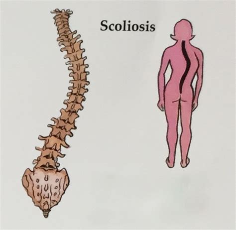 Adult Scoliosis Spinecare Medical Group