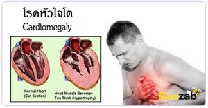 หัวใจโต ( cardiomegaly ) ภาวะหัวใจใหญ่กว่าปกติ ทำให้ความดันโลหิตสูง แต่หัวใจสูบฉีดเลือดได้ไม่ดี อาการเหนื่อยง่าย หายใจเร็ว เวียนหัว อ่อนเพลีย เท้า. โรคหัวใจโต อาการหัวใจสูบฉีดเลือดไม่ดี อันตรายหัวใจวายได้