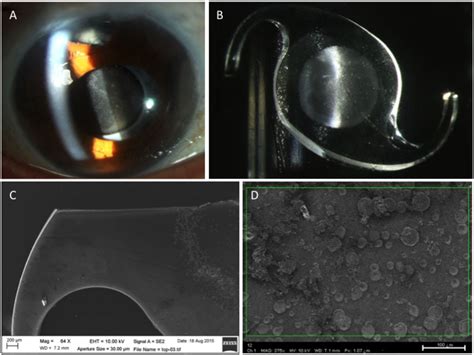 Opacification Of Hydrophilic Intraocular Lenses Associated With